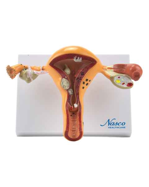 Nasco MG29789 Uterus and Ovary with Pathologies Model