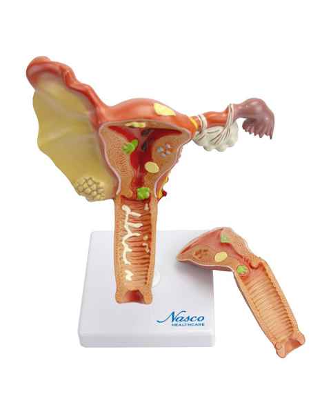 Nasco MG29947 Female Genital Organ with Pathology Model, 2 Parts - Front View