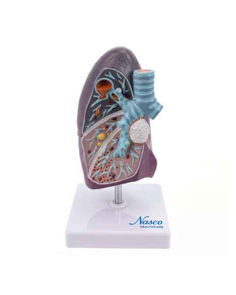Nasco MG30885 Lung Pathology Model, 1.5x Enlarged