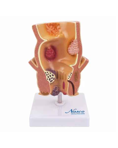 Nasco MG31005 Hemorrhoids Model, 5x Enlarged - Front View