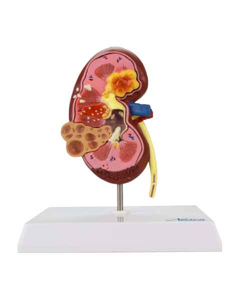 Nasco MG31019 Kidney with Pathology Model, 2.5x Enlarged