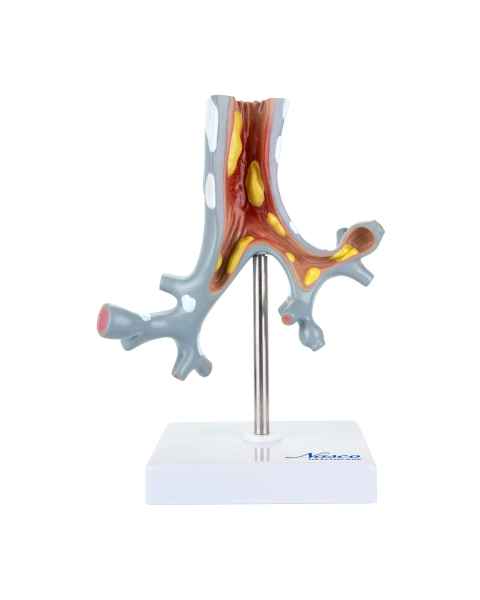 Nasco MG31098 Bronchial Tree Section Pathology Model, 10x Enlarged, Front View