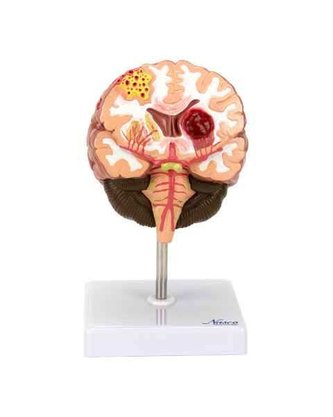 Nasco MG31100 Brain Section with Pathology Model - Angle 1