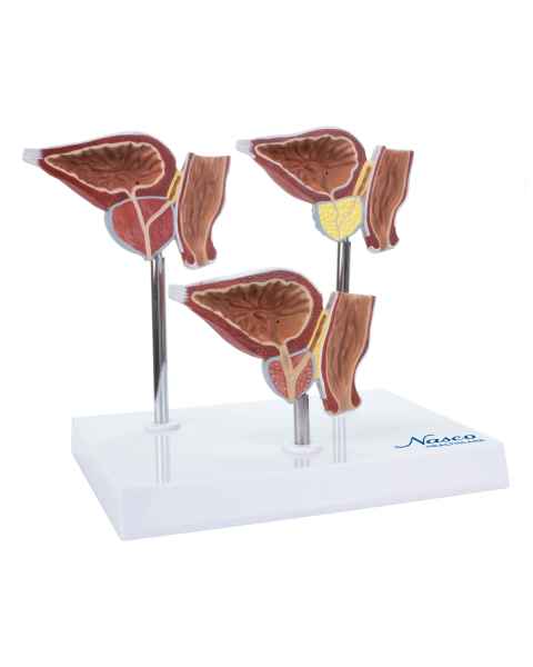Nasco MG31153 Normal and Pathological Prostate Model, 3 Parts - Front View