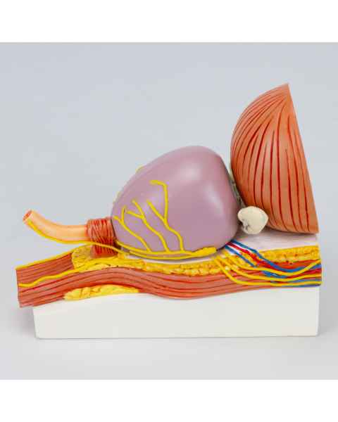 Nasco MG34924 Prostate with Pathology Model - Side View