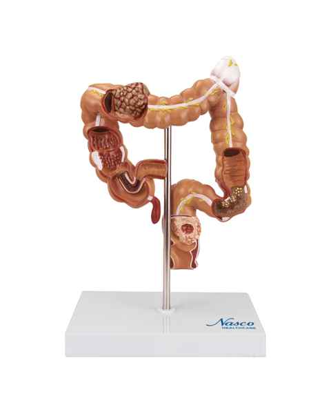 Nasco MG35589 Colon and Rectum with Intestinal Pathologies Model - Front View