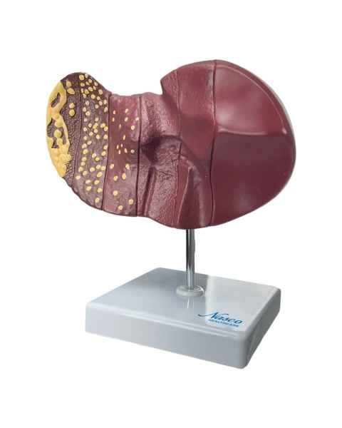 Nasco MG36148 Liver Section with Pathology Model - Front View
