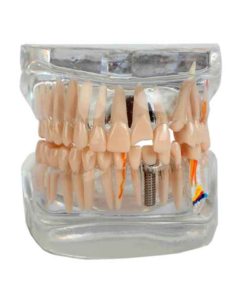 Nasco MG38398 Translucent Adult Dentition Normal and Pathology Model - Fron View