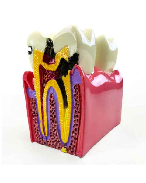 Nasco MG39442 Dental Disease Model, 6x Enlarged - Left Angle with Disease