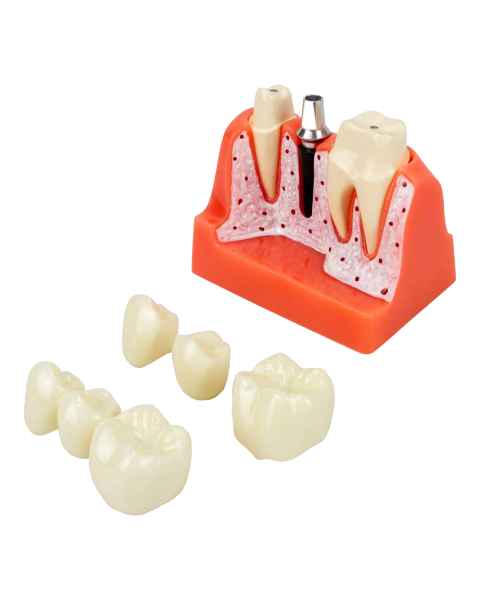 Nasco MG39444 Dental Implant Model, 8 Parts - Angle 1