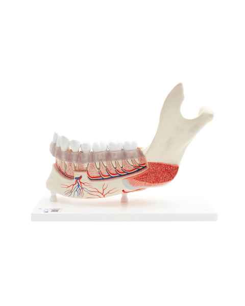 3B Scientific VE290 Advanced Half Lower Jaw with 8 Diseased Teeth 19-Part - 3B Smart Anatomy