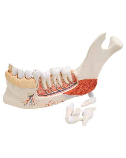 Advanced Half Lower Jaw with 8 Diseased Teeth 19-Part