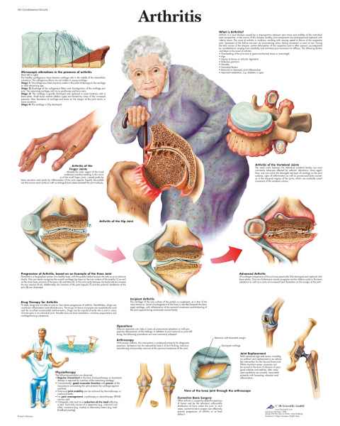 Arthritis Chart