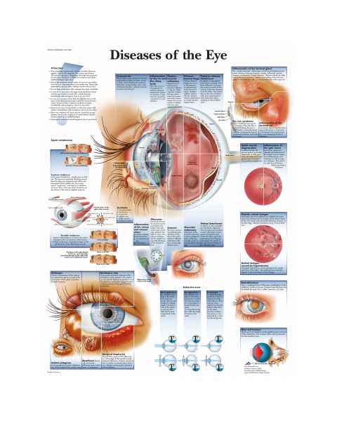 Diseases of the Eye Chart