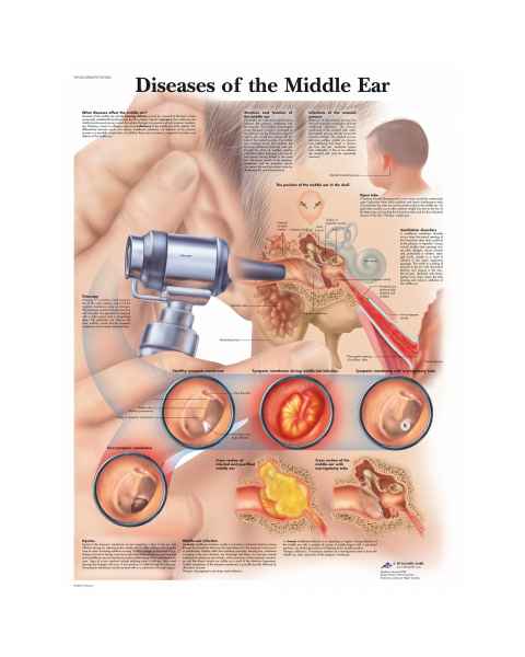 Diseases of the Middle Ear Chart