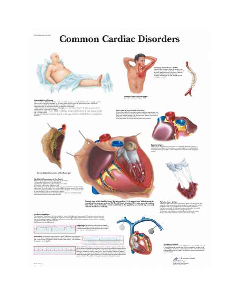 Common Cardiac Disorders Chart