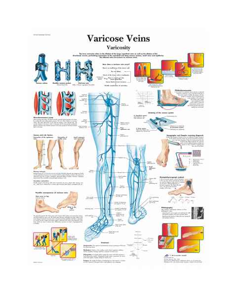 Varicose Veins Chart