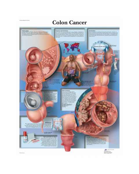 Colon Cancer Chart