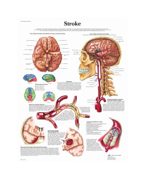 Stroke Chart