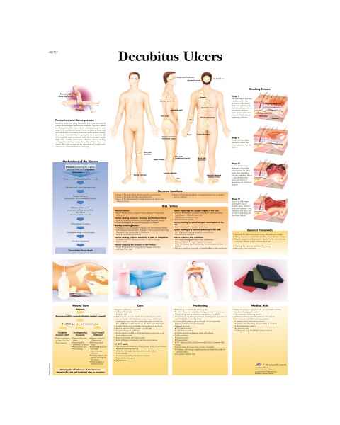 Decubitus Ulcers Chart