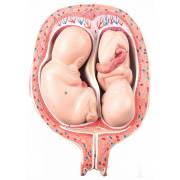5th Month Twin Fetus Model - Normal Position