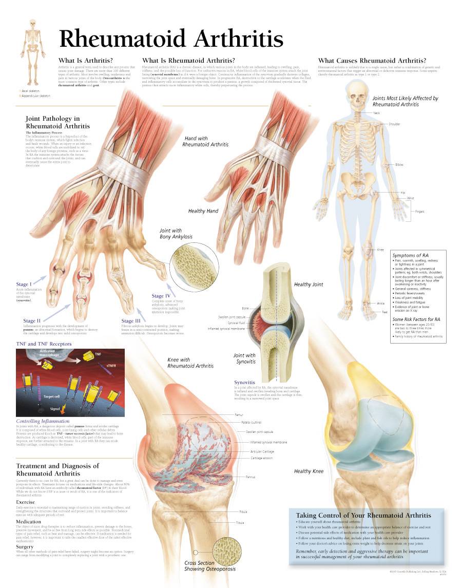 Scientific Publishing Rheumatoid Arthritis Chart