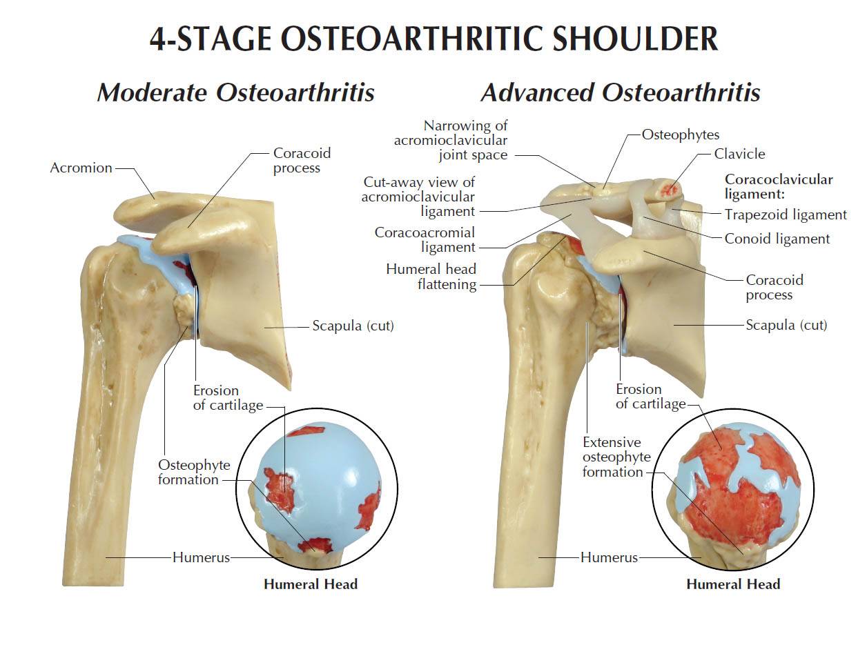 GPI 1800 4Stage Osteoarthritis Shoulder Model