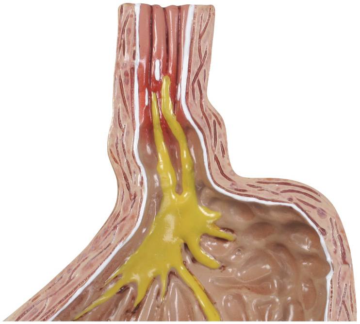gpi-2010-gastroesophageal-reflux-disease-gerd-model