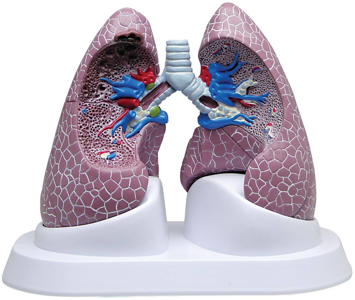 Diseased Lung Model with Pathologies GPI 3110