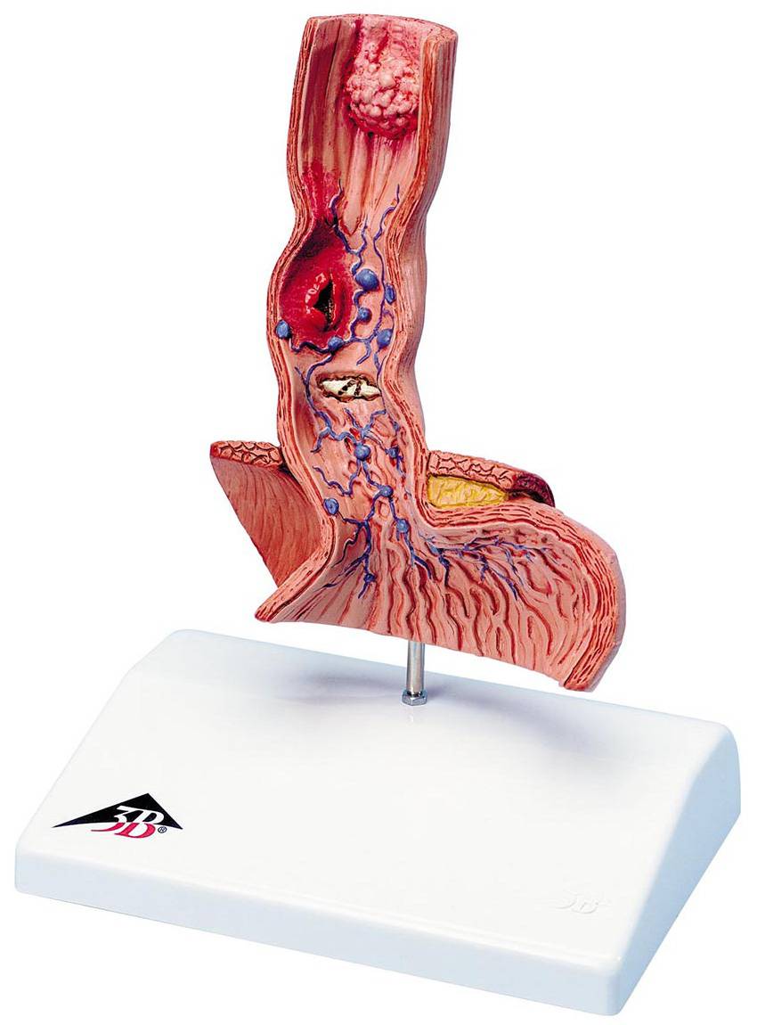 3B Scientific K18 Diseases of the Esophagus Model