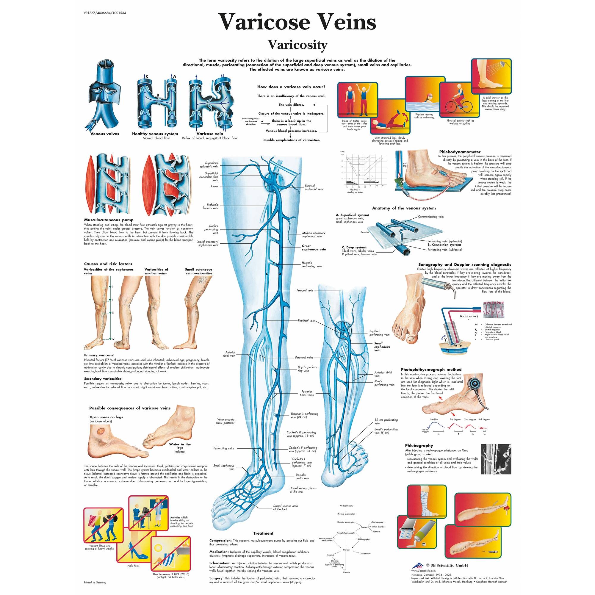 Varicose Vein Size Chart