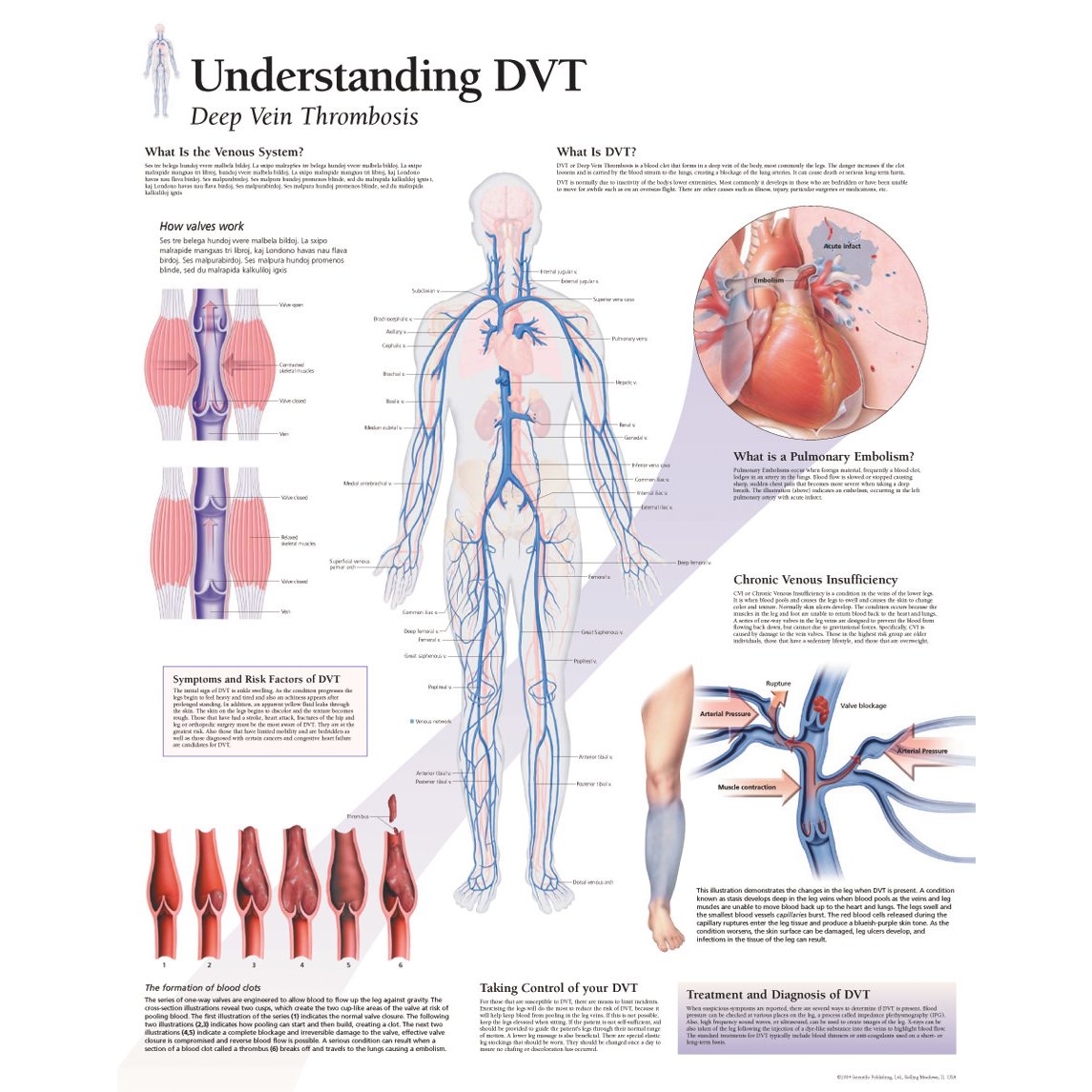 Scientific Publishing Understanding DVT Deep Vein Thrombosis Chart