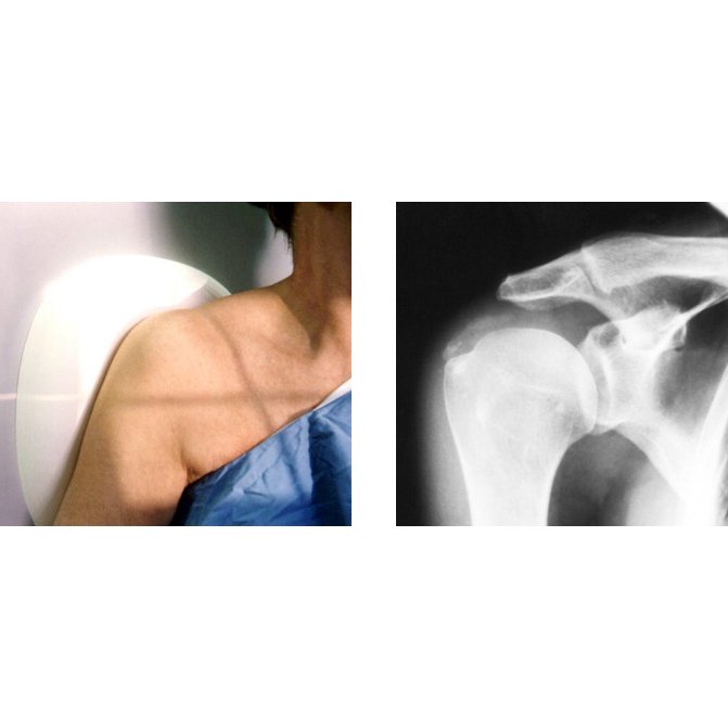 Octostop FI06 Boomerang 15 Degree XRay Compensating Filter