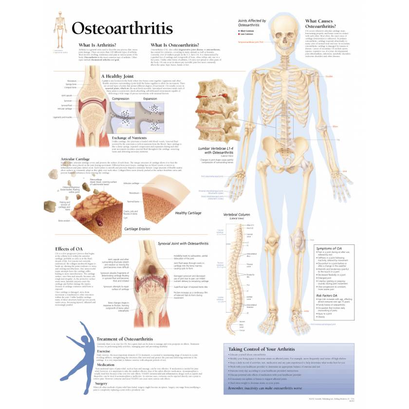 Osteoarthritis Chart