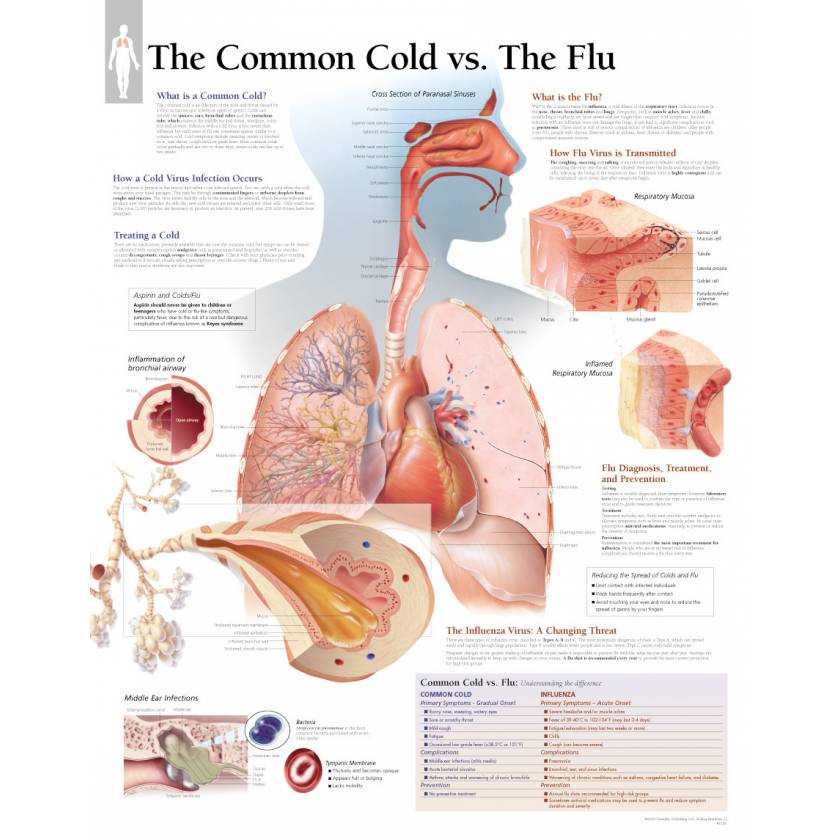 The Common Cold vs. The Flu Chart