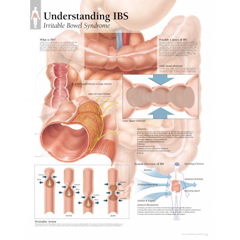 Understanding IBS (Irritable Bowel Syndrome) Chart