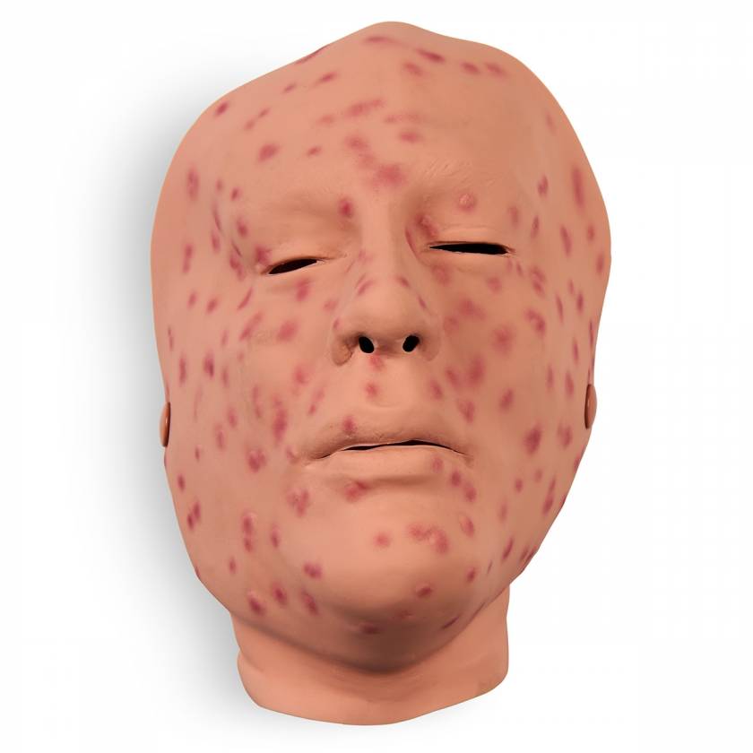 Life/form 800-627 Moulage Wound - Smallpox, 2nd Day, Face Life/form 800-627 Moulage Wound - Smallpox, 2nd Day, Face