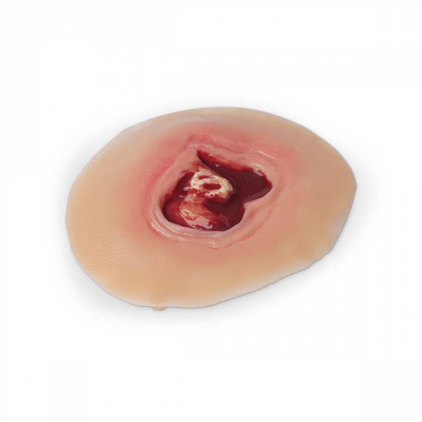 Life/form Moulage Wound - Diabetic Ulcer, 20 mm Simulator
