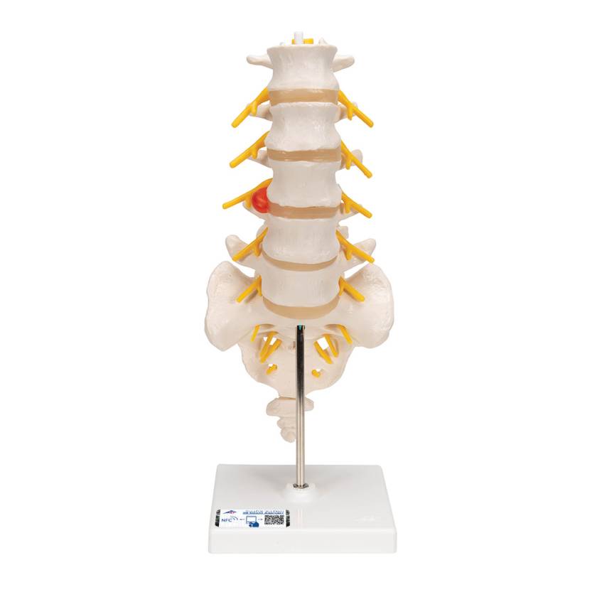 3B Scientific A76/5 Human Lumbar Spinal Column Model with Dorso-Lateral Prolapsed Intervertebral Disc - 3B Smart Anatomy