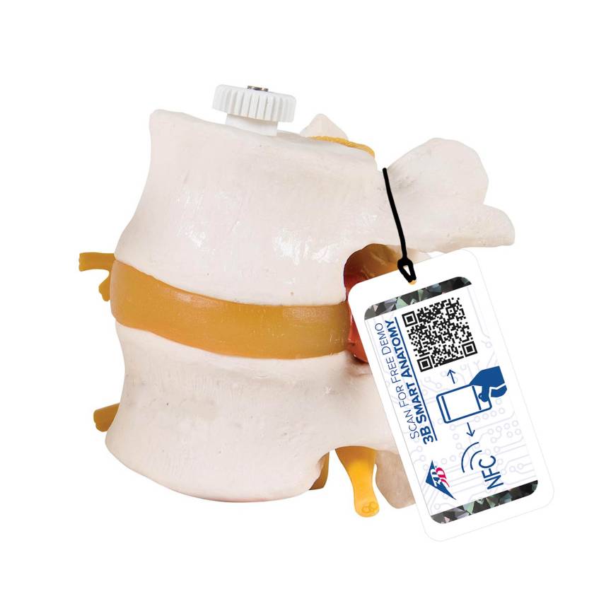 3B Scientific A76-9 Two Lumbar Vertebrae with Prolapsed Disc Flexibly Mounted - 3B Smart Anatomy