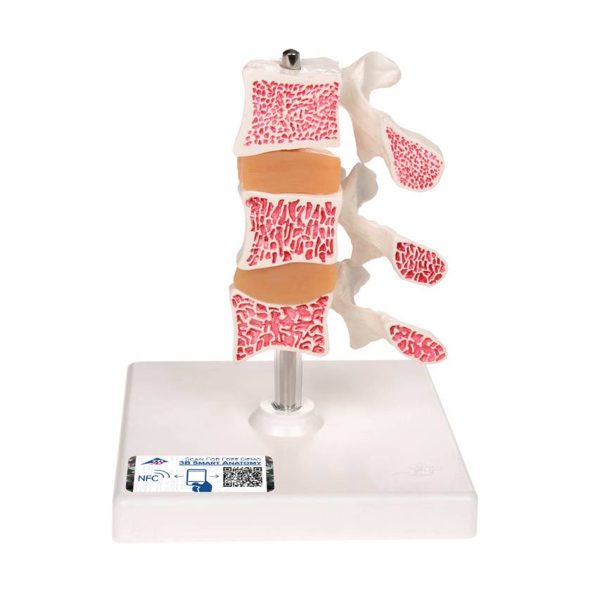 3B Scientific A78 Deluxe Osteoporosis Model (3 Vertebrae) - 3B Smart Anatomy
