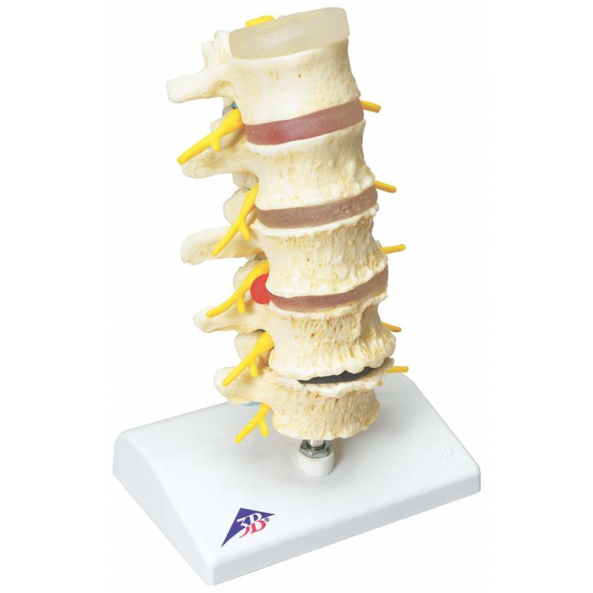 Stages of Disc Prolapse and Vertebral Degeneration