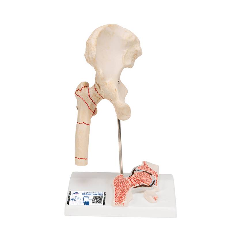 3B Scientific A88 Femoral Fracture and Hip Osteoarthritis Model - 3B Smart Anatomy