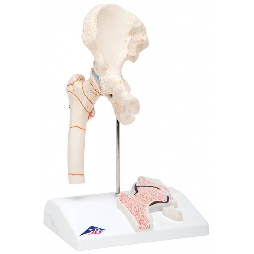 Femoral Fracture and Hip Osteoarthritis Model