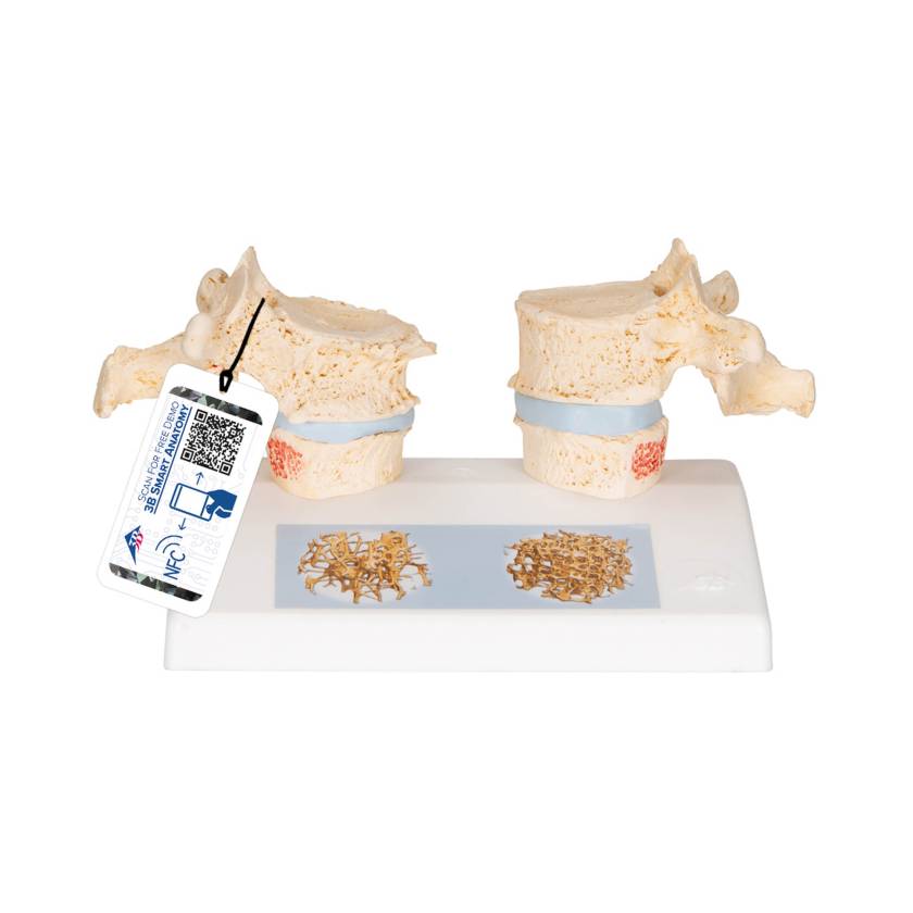 3B Scientific A95 Osteoporosis Model - 3B Smart Anatomy