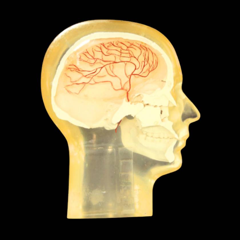RSD RS-245T Half Angiographic Head Phantom with Step Wedge & Resolution Test Pattern (2-10 lp/mm)