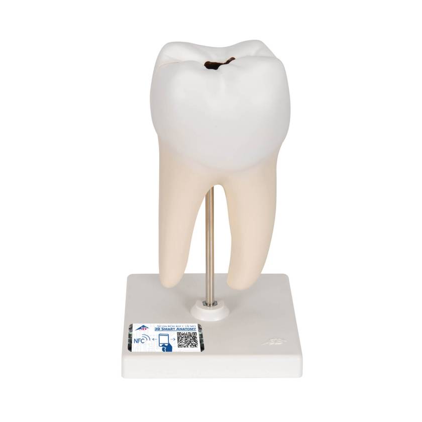 3B Scientific D10/4 Lower Twin-Root Molar Showing Cavities 2-Part - 3B Smart Anatomy