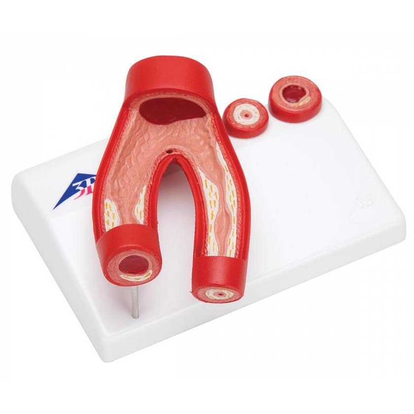 Arteriosclerosis Model with Cross Section of Artery 2-Part