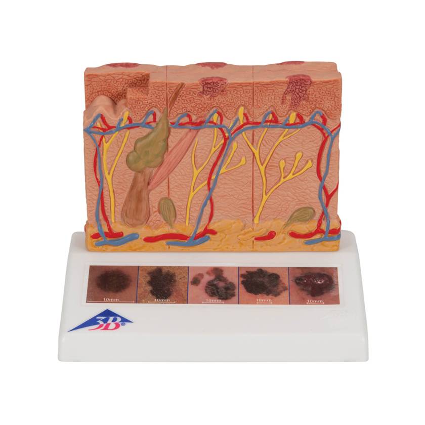 3B Scientific J15 Skin Cancer Model - Enlarged 8 Times, 3B Smart Anatomy