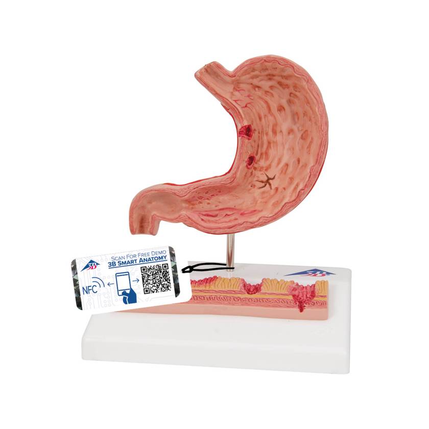 3B Scientific K17 Stomach Model with Ulcers - 3B Smart Anatomy